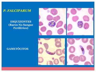 P. FALCIPARUM
ESQUIZONTES
(Raros No Sangue
Periférico)

GAMETÓCITOS

 