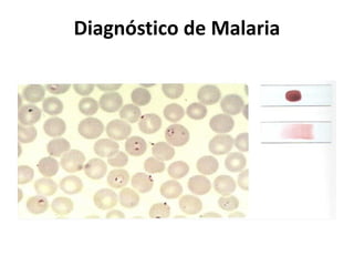 Diagnóstico de Malaria 