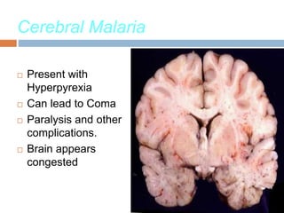 Cerebral Malaria
 Present with
Hyperpyrexia
 Can lead to Coma
 Paralysis and other
complications.
 Brain appears
congested
 