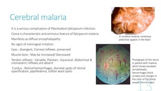 Cerebral malaria
It is a serious complication of Plasmodium falciparum infection.
Coma is characteristic and ominous feature of falciparum malaria
Manifests as diffuse encephalopathy
No signs of meningeal irritation
Eyes : divergent, Corneal reflexes :preserved
Muscle tone : May be Increased/ Decreased
Tendon reflexes : Variable, Plantars : Equivocal. Abdominal &
cremasteric reflexes are absent
Fundus : Retinal hemorrhages, discreet spots of retinal
opacification, papilledema, cotton wool spots
In cerebral malaria, numerous
petechiae appear in the brain.
Photograph of the retina
in patient with malaria,
which shows exudates
(arrowheads),
hemorrhages (thick
arrows) and changes in
the color of the blood
vessels (thin arrows).
 