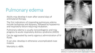 Pulmonary edema
Adults may develop it even after several days of
antimalarial therapy.
The first indications of impending pulmonary edema
include tachypnea and dyspnea, followed by hypoxemia
and respiratory failure requiring intubation.
Pulmonary edema is usually noncardiogenic and may
progress to acute respiratory distress syndrome (ARDS)
Can be aggravated by overly vigorous administration of IV
fluids.
It can also develop in otherwise uncomplicated vivax
malaria
Mortality is >80%.
Severe pulmonary edema in a patient with
severe P. falciparum malaria.
Acute pulmonary oedema, developing shortly after
delivery in a woman with severe P. falciparum malaria
 
