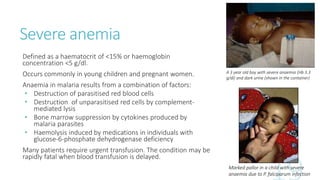 Severe anemia
Defined as a haematocrit of <15% or haemoglobin
concentration <5 g/dl.
Occurs commonly in young children and pregnant women.
Anaemia in malaria results from a combination of factors:
• Destruction of parasitised red blood cells
• Destruction of unparasitised red cells by complement-
mediated lysis
• Bone marrow suppression by cytokines produced by
malaria parasites
• Haemolysis induced by medications in individuals with
glucose-6-phosphate dehydrogenase deficiency
Many patients require urgent transfusion. The condition may be
rapidly fatal when blood transfusion is delayed.
Marked pallor in a child with severe
anaemia due to P. falciparum infection
A 3 year old boy with severe anaemia (Hb 3.3
g/dl) and dark urine (shown in the container)
 