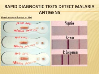 Plastic cassette format of RDT
RAPID DIAGNOSTIC TESTS DETECT MALARIA
ANTIGENS
 
