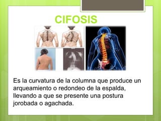 Es la curvatura de la columna que produce un
arqueamiento o redondeo de la espalda,
llevando a que se presente una postura
jorobada o agachada.
CIFOSIS
 