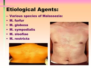 Etiological Agents:
– Various species of Malassezia:
• M. furfur
• M. globosa
• M. sympodialis
• M. sloofiae
• M. restricta
 