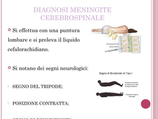DIAGNOSI MENINGITE
CEREBROSPINALE
 Si effettua con una puntura
lombare e si preleva il liquido
cefalorachidiano.
 Si notano dei segni neurologici:
- SEGNO DEL TRIPODE;
- POSIZIONE CONTRATTA;
 