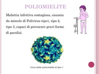 POLIOMIELITE
Malattia infettiva contagiosa, causata
da miscele di Polivirus tipo1, tipo 2,
tipo 3, capaci di provocare gravi forme
di paralisi.
 