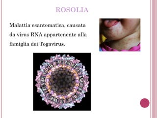 ROSOLIA
Malattia esantematica, causata
da virus RNA appartenente alla
famiglia dei Togavirus.
 