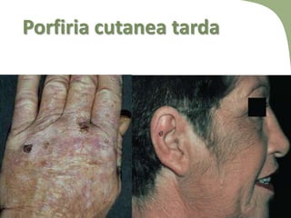 Porfiria cutanea tarda
 