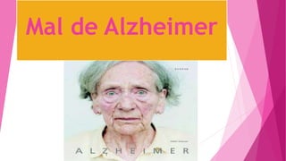 Mal de Alzheimer
 