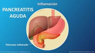 PANCREATITIS
AGUDA
 