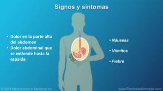 • Dolor en la parte alta
del abdomen
• Dolor abdominal que
se extiende hasta la
espalda
 