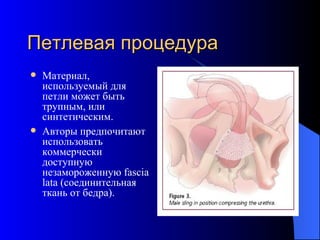 Петлевая процедура Материал, используемый для петли может быть трупным, или синтетическим.  Авторы предпочитают использовать коммерчески доступную незамороженную  fascia lata  (соединительная ткань от бедра). 