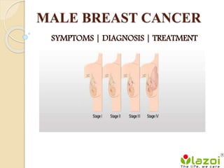 MALE BREAST CANCER
SYMPTOMS | DIAGNOSIS | TREATMENT
 