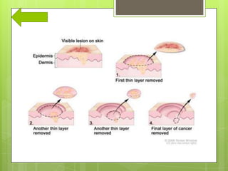 Male cancers