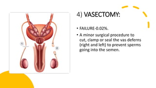 4) VASECTOMY:
• FAILURE-0.02%.
• A minor surgical procedure to
cut, clamp or seal the vas deferns
(right and left) to prevent sperms
going into the semen.
 