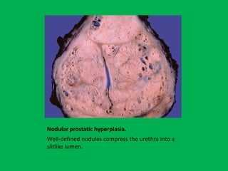 Male genital system and lower urinary tract and Sexually Transmitted ...