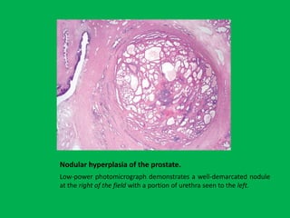 Male genital system and lower urinary tract and Sexually Transmitted ...