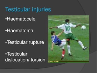 Testicular injuries
•Haematocele
•Haematoma
•Testicular rupture
•Testicular
dislocation/ torsion
 