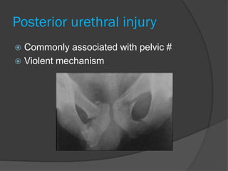 Posterior urethral injury
 Commonly associated with pelvic #
 Violent mechanism
 