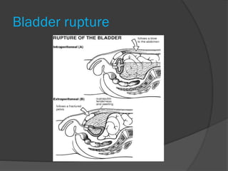 Bladder rupture
 