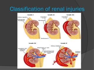 Classification of renal injuries
 