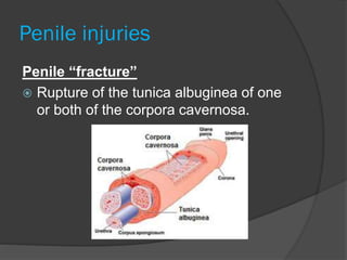Penile injuries
Penile “fracture”
 Rupture of the tunica albuginea of one
or both of the corpora cavernosa.
 