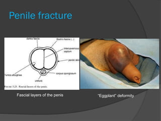 Penile fracture
“Eggplant” deformityFascial layers of the penis
 