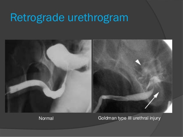 retrograde urethrogram