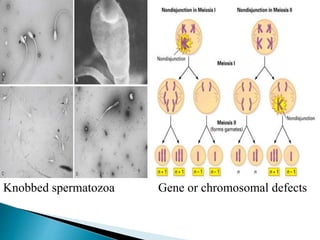 Knobbed spermatozoa Gene or chromosomal defects
 