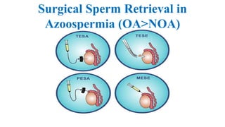 Surgical Sperm Retrieval in
Azoospermia (OA>NOA)
 