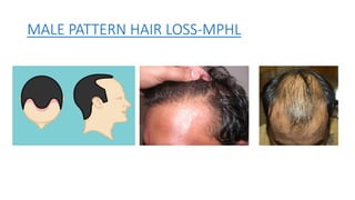 Male pattern hair loss practical guide to hair transplantation chapter ...