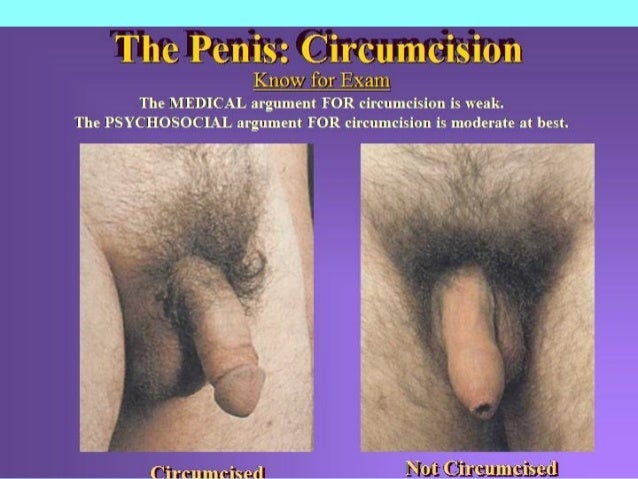 How To Circumsize A Penis 115
