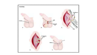 Male sterilization- A SHORT NOTE
