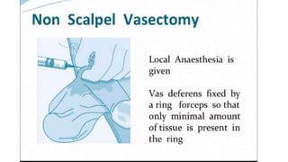 Male sterilization- A SHORT NOTE