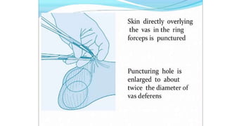 Male sterilization- A SHORT NOTE