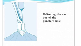 Male sterilization- A SHORT NOTE