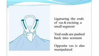 Male sterilization- A SHORT NOTE