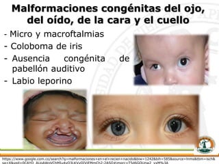 Malformaciones congénitas del ojo,
del oído, de la cara y el cuello
- Micro y macroftalmias
- Coloboma de iris
- Ausencia congénita de
pabellón auditivo
- Labio leporino
https://www.google.com.co/search?q=malformaciones+en+el+recien+nacido&biw=1242&bih=585&source=lnms&tbm=isch&
 
