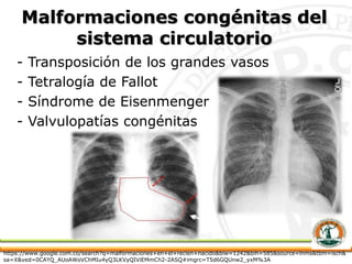Malformaciones congénitas del
sistema circulatorio
- Transposición de los grandes vasos
- Tetralogía de Fallot
- Síndrome de Eisenmenger
- Valvulopatías congénitas
https://www.google.com.co/search?q=malformaciones+en+el+recien+nacido&biw=1242&bih=585&source=lnms&tbm=isch&
sa=X&ved=0CAYQ_AUoAWoVChMIu4yQ3LKVyQIViEMmCh2-2ASQ#imgrc=T5d6GQUnw2_yxM%3A
 