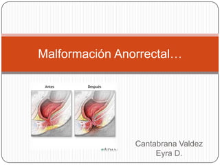 Malformación Anorrectal…




                Cantabrana Valdez
                     Eyra D.
 