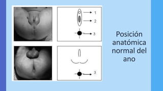 Posición
anatómica
normal del
ano
 