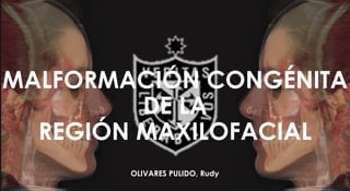 MALFORMACIÓN CONGÉNITA DE LA REGIÓN MAXILOFACIAL 
OLIVARES PULIDO, Rudy  