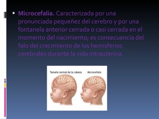 Microcefalia.  Caracterizada por una pronunciada pequeñez del cerebro y por una fontanela anterior cerrada o casi cerrada en el momento del nacimiento; es consecuencia del falo del crecimiento de los hemisferios cerebrales durante la vida intrauterina. 
