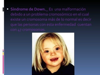 Síndrome de Down._  Es  una malformación debido a un problema cromosómico en el cual existe un cromosoma más de lo normal es decir que las personas con esta enfermedad  cuentan con 47 cromosomas. 