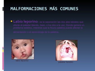 MALFORMACIONES MÁS COMUNES Labio leporino :  es la separación las dos alas labiales que afecta al paladar blando, óseo, o los dos a la vez. Donde genera un problema estético, mientras que la fisura palatina puede afectar la alimentación o el aprendizaje de la palabra . 