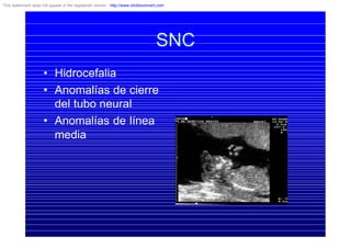 SNC
• Hidrocefalia
• Anomalías de cierre
del tubo neural
• Anomalías de línea
media
This watermark does not appear in the registered version - http://www.clicktoconvert.com
 