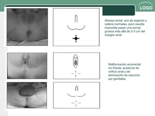 LOGO

Atresia rectal: ano de aspecto y
calibre normales, pero resulta
imposible pasar una sonda
gruesa más allá de 2-3 cm del
margen anal.




  Malformación anorrectal
  sin fístula: ausencia de
  orificio anal y de
  eliminación de meconio
  por genitales.
 