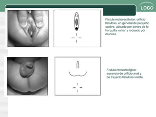 LOGO

Fístula rectovestibular: orificio
fistuloso, en general de pequeño
calibre, ubicado por dentro de la
horquilla vulvar y rodeado por
mucosa.




Fístula rectourológica:
ausencia de orificio anal y
de trayecto fistuloso visible.
 
