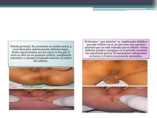 Fístula perineal. Se presentan en ambos sexos, y
eran llamados anteriormente defectos bajos.
Están representados por los casos en los que el
recto se abre en un pequeño orificio, usualmente
estenótico y siempre localizado anterior al centro
del esfinter.
El término “ ano anterior” es inadecuado debido a
que éste orificio no es un ano sino una apertura
anormal que no está rodeada por el esfínter. Estos
defectos pueden corregirse en el periodo neonatal
sin colostomía previa. El mecanismo esfinteriano
es bueno y el sacro no presenta anomalías.
 